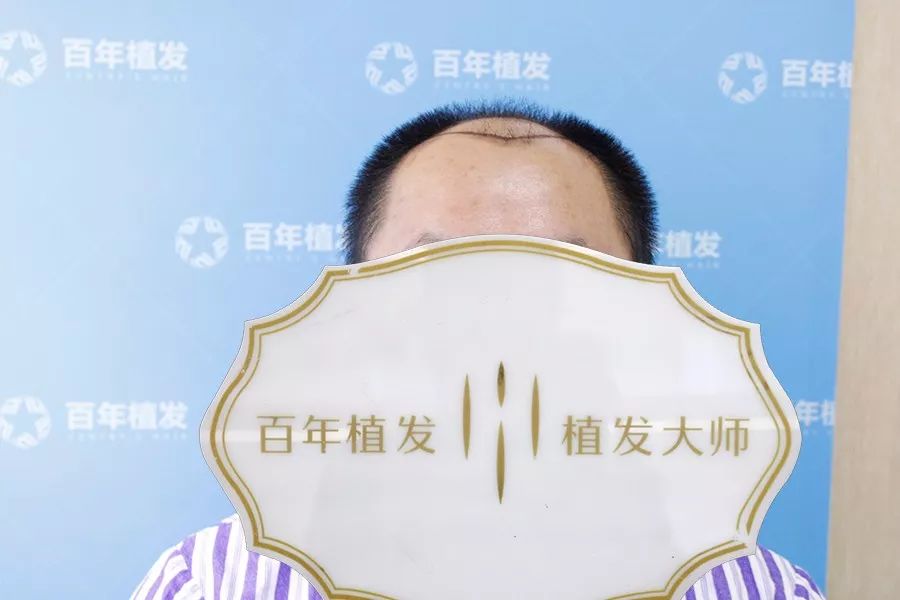 秃顶头发种植4000单位后失地成功收复