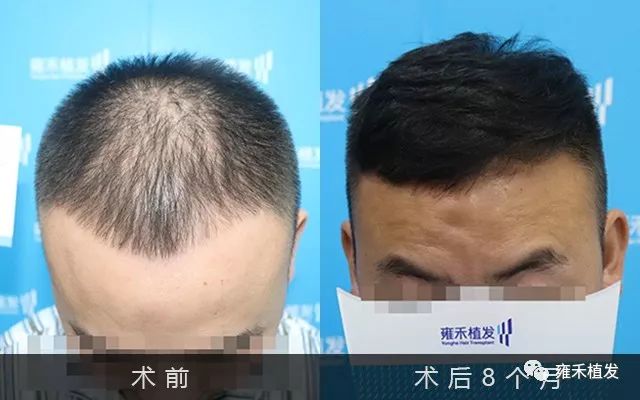 发际线后退重庆植发2366单位8月就OK