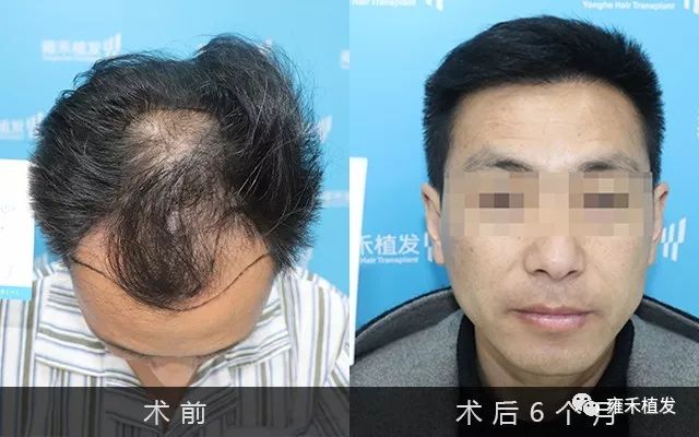 老师豁出去贵阳植发种植3000单位效果
