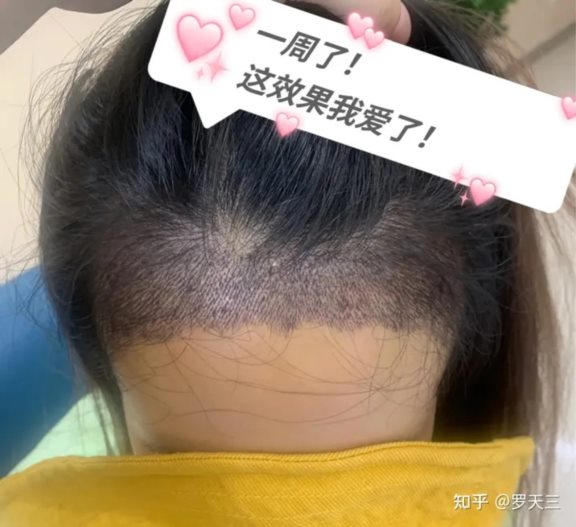 大麦微针植发术后一周，想植发的姐妹看过来!