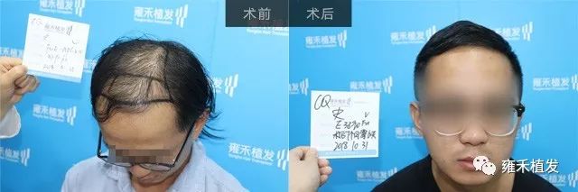重庆雍禾采用FUE为史先生植发3950单位半年出效果