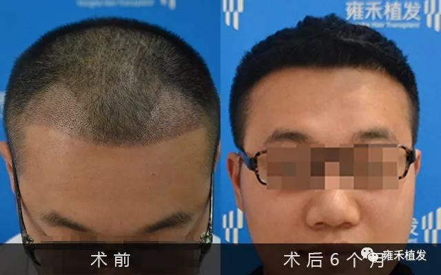 南宁雍禾采用FUE为小邓种植1820单位南宁植发