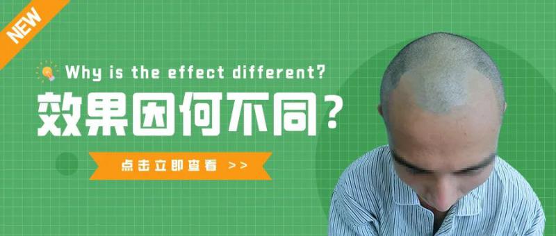 同样的脱发面积，同样的种植单位，效果为何不同？
