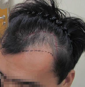 M型脱发治疗，植发效果案例分享