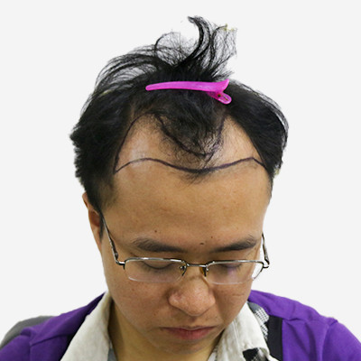 脱发只是时刻未到，到了就做个植发恢复