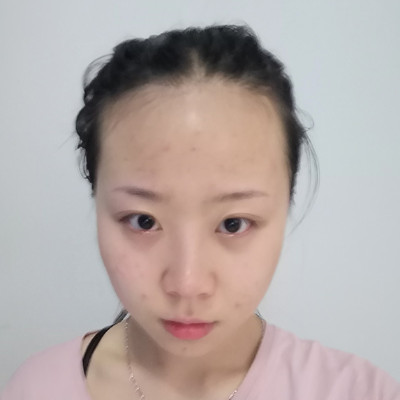 植发际线修饰你的脸型效果非常好，术后对比图片