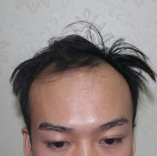 发际线调整 前额加密种植3355个单位效果分享