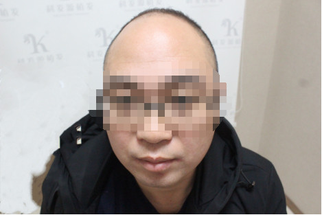 大麦科发源植发亲身经历植发后头发密密麻麻效果有目共睹