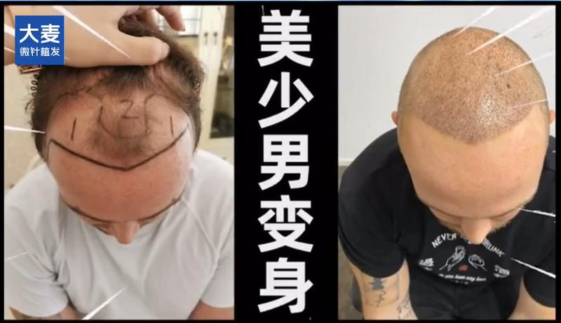 网红桑德来大麦植发啦！植发记录视频从卤蛋变身美少男的经历