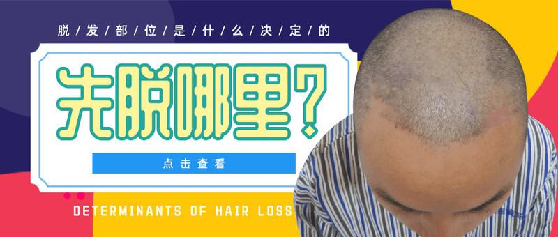 发际线还在，头顶没了！脱发部位是什么决定的？