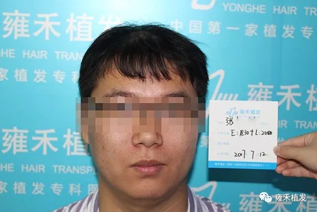 植发不分四季7月植发3800单位武汉雍禾效果