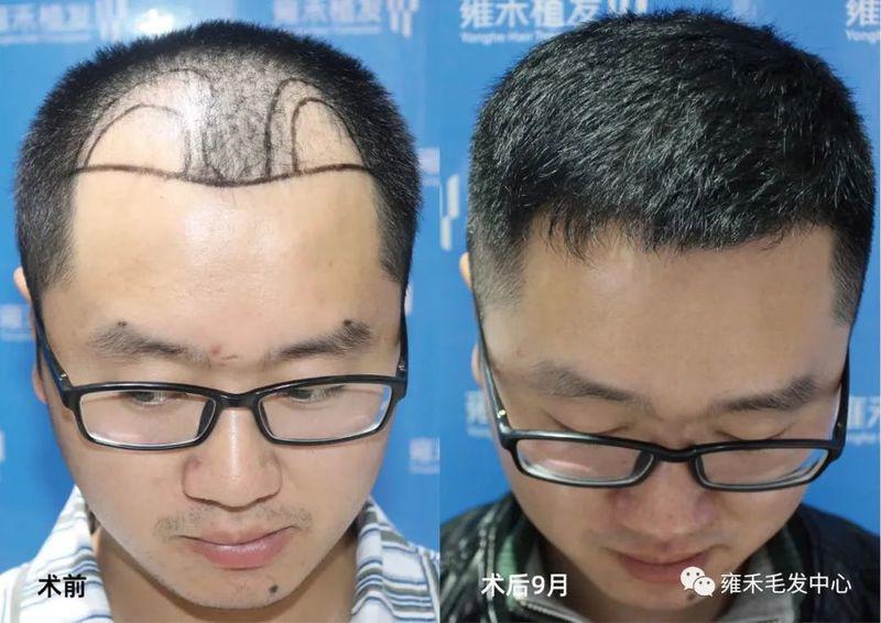 福州雍禾为林先生种植2570单位现在植发快两年了