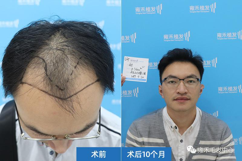 贵阳雍禾采用FUE为杜先生种植3650单位节约型植发