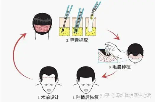 选择植发医院植发时，需要考虑什么？