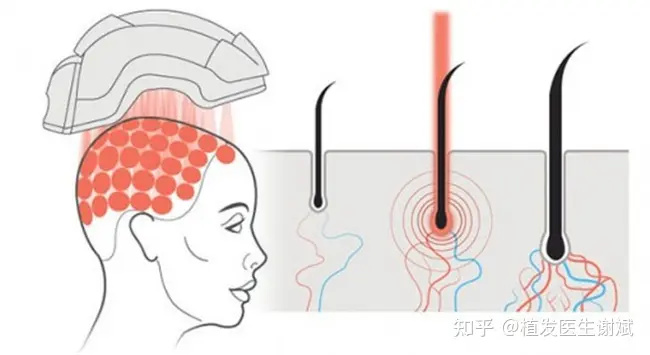 不打针不吃药不抹药，激光生发的真相是什么？